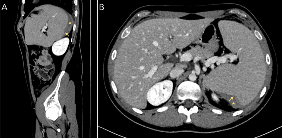 A 30 Year Old Male With Spontaneous Splenic Rupture | The Hematologist ...