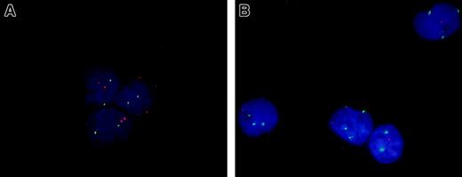 Fig. 4. Dual FISH analysis of CD34+CD38− cells from an MDS case with both del(5q) and trisomy 8. / Purified BM CD34+CD38− cells from a healthy donor (A) and an MDS case with both del(5q) and trisomy 8 (B) were subjected to dual FISH analysis. The nuclei of cells with normal chromosome 5 and 8 status display 2 orange (5q) and 2 green (8) signals (all 3 cells in panel A). In panel B all 4 nuclei had del(5q) and 3 of these displayed +8 in addition. Original magnification approximately × 1000.