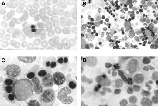 Fig. 1. Optical microscopy morphology of peripheral and bone marrow hematopoiesis. / Binucleate erythroblast in peripheral blood (A). Erythroid hyperplasia with marked abnormalities (binucleate, trinucleate, and multinucleate late erythroblasts) (B,C,D). Abnormal erythroblasts showing anomalous distribution of chromatin (C,D), binucleate erythroblasts, and isolated trinuclear, tetranuclear (B), and aberrant multinuclear erythroblasts (B,D). May-Grünwald-Giemsa stain. Original magnifications: A and D, × 400; B, × 200; C, × 1000.