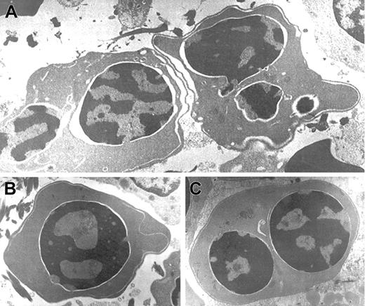 Fig. 2. Electron micrographs of several bone marrow late erythroblasts. / Multinucleate erythroblasts showing striking “double membranes” with partial dilatation of the intramembranous space (A). Erythroblasts revealing nondilated cisternae (B,C). Late erythroblast depicting spongy heterochromatin with numerous “punched out” areas (B). Binucleate erythroblasts showing large areas of nuclear membrane without attached heterochromatin (C). Uranyl acetate and lead citrate stain. Original magnification: A, × 10 600; B and C, × 18 000).