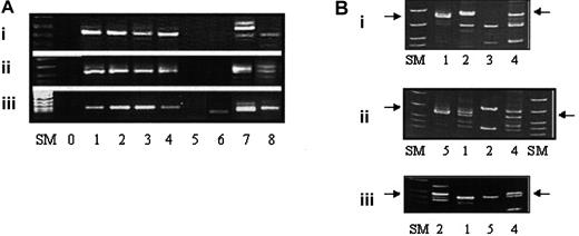 Fig. 1. Analysis of leukemia-specific IgH rearrangements in single leukemic cells and neonatal blood spots of a patient with hyperdiploid ALL. / A 2-round nested clone-specific PCR was performed, and products were size fractionated on 2.5% agarose (A) or 4% to 12% polyacrylamide gels (B). (Ai) DH3-22/J5 rearrangement of 224 base pairs; (Aii) VH3/DH3-22/J5 rearrangement of 169 base pairs; and (Aiii) VH3/DH2-22/J4 rearrangement of 125 base pairs. (A) SM size marker VIII (Roche, Mannheim, Germany), lane 0, no DNA; lanes 1 to 5, dilutions of leukemic cell DNA into peripheral blood DNA 10−2 to 10−6; lane 6, DNA from control Guthrie card; lane 7, DNA from the patient's Guthrie card; lane 8, PCR product from a representative single cell. (B) SM size marker, lane 1, peripheral blood DNA from healthy donors; lane 2, DNA from the patient's Guthrie card; lane 3, DNA from control Guthrie card; lane 4, single leukemia cell; lane 5, dilution of DNA from leukemic cells into peripheral blood DNA 10−5. Arrows indicate the size of specific PCR products. Sequencing of all PCR products of the expected size confirmed identity with the original rearrangements. These data were reproduced in a second experiment (data not shown).