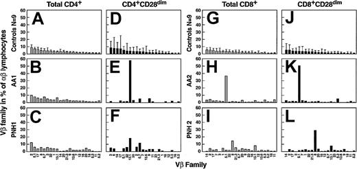 Fig. 1. Flow cytometric analysis of the TCR-Vβ usage in AA patients. / For controls (n = 9; A,D,G,J), columns and bars represent mean + 2 SD of percentages of lymphocytes belonging to a particular Vβ family as indicated on the x-axis. The values are calculated as percentages of total αβ CD4+ (A,B,C) or CD8+ (G,H,I) lymphocytes. Similarly, contribution of individual Vβ families is represented as percentage of total αβ CD4+CD28dim (D,E,F) and αβ CD8+CD28dim (J,K,L) lymphocytes. For AA (B,E,H,K) and PNH patients (C,F,I,L), 2 representative cases (of a total of 33 studied) are shown.