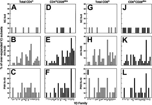 Fig. 3. Frequency of expansion of individual Vβ families in AA. / Results represent a summary of all patients analyzed by flow cytometry. Columns correspond to percentage of cases in which the pathologic expansion was found. Results in total αβ CD4+ (A,B,C,D) and αβ CD8+ (G,H,I) cells are represented. By analogy, results within the effector (CD28dim) pool for CD4+ (D,E,F) and CD8+ (J,K,L) lymphocytes are depicted.