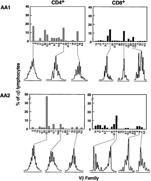 Fig. 4. TCR-Vβ CDR3 size distribution analysis of expanded Vβ families in AA. / Two representative examples (patients AA1 and AA 2) are shown (of 20 performed). Columns represent percentages of lymphocytes belonging to a particular Vβ family as indicated on the x-axis. For overexpanded families, the results of the Vβ CDR3 size distribution analysis are depicted below each panel. For the spectrograms, the x-axis represents size of the PCR amplification product fragments as determined using fluorescent sequencing technique.
