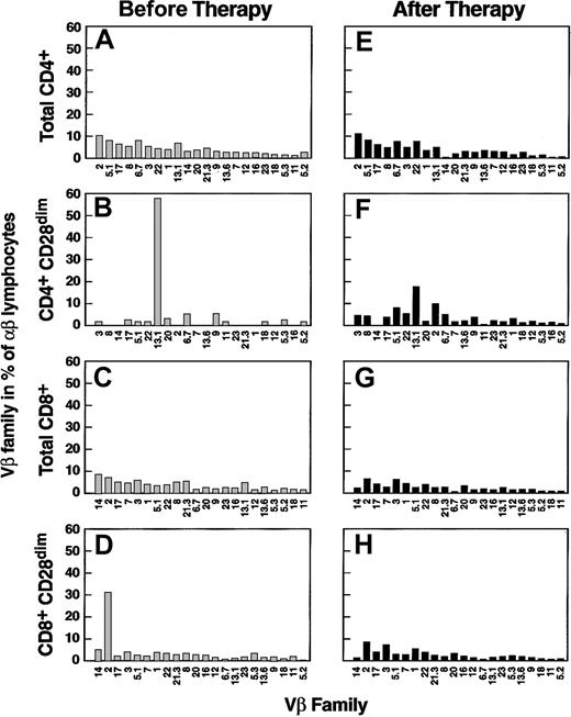 Fig. 5. Preferential usage of Vβ families in AA patients prior to and after immunosuppressive therapy. / Two representative cases are shown, one for CD4+lymphocytes (A,B,E,F) and one for CD8+ lymphocytes (C,D,G,H); results in total cells (A,E,C,G) and effector pool (B,D,F,H) are depicted. Vβ usage prior to immunosuppressive treatment (B,F,D,H) is represented, whereas the corresponding results after therapy was administered (E,F,G,H) according to the regimen described in “Patients and methods” are shown.