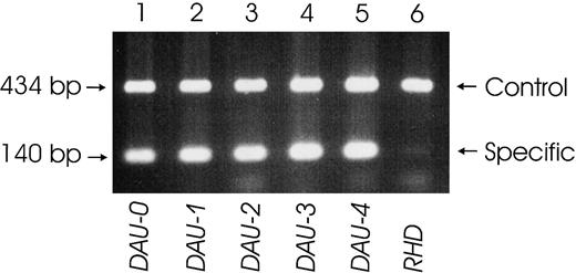 Fig. 2. Specific detection of the T379M substitution by PCR-SSP. / A PCR-SSP was devised that amplified a specific 140-bp product from the aberrant RHD exon 8 in all DAU alleles tested (lane 1: DAU-0; lane 2: DAU-1; lane 3:DAU-2; lane 4: DAU-3; lane 5: DAU-4). In a normal D-positive sample (lane 6), only the 434-bp control product deriving from the human growth hormone gene is amplified.