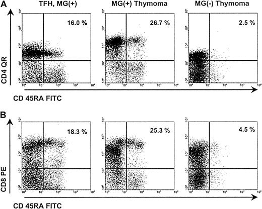 Fig. 2. Representative results of FACS analysis of MG(+) and MG(−) thymomas. / FACS analysis of naive CD4+ and CD8+ subsets in a nonneoplastic thymus control (patient 24), a WHO type B2 thymoma with MG (patient 3), and a WHO type AB thymoma without MG (patient 10). Both subsets are highly reduced in the MG(−) thymoma compared with the control thymus and the MG(+) thymoma.