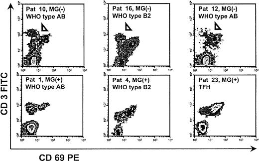 Fig. 3. Detection of a peculiar, presumably apoptotic, CD4+CD3highCD69− thymocyte population in 3 MG(−) thymomas (arrowheads). / FACS analysis after depletion of CD8+ cells. All other applied surface markers, including CD1a, CD25, CD45RA, and CD45RO, were negative (not shown).