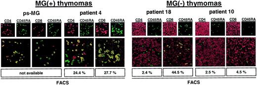 Fig. 5. Naive CD4+ T cells are present in a thymoma with ps MG. / Confocal laser scanning microscopy analysis of the thymomas of a patient with ps-MG and of a representative patient with development of MG before thymoma detection showing abundant naive CD4+ T cells in both tumors. By contrast, naive CD4+ T cells were almost undetectable in 2 MG(−) thymomas. Moreover, naive CD8+ T cells were virtually absent in one MG(−) thymoma (patient 10). Sections were double stained with either CD4-Cy3 (red) and CD45RA-Cy2 (green) or CD8-Cy3 (red) and CD45RA-Cy2 (green). Cells with double staining show a yellow fluorescence in electronic overlays of the red and green images. Percentages of naive T-cell subsets as determined by flow cytometry (Table 2) are given at the bottom of each panel for comparison. Images are representative of at least 20 microscopic high-power fields studied per double staining in each patient. Original magnification, × 400.