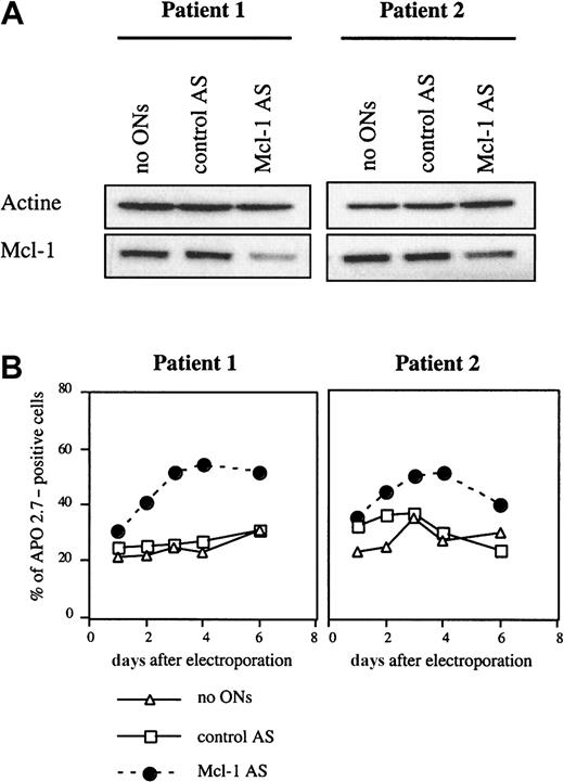 Fig. 7. Mcl-1 ASO triggered apoptosis in myeloma cells from 2 patients. / (A) Mcl-1 protein was down-regulated after treatment by Mcl-1 ASO. Cells from patients were electroporated in the presence 20 μM Mcl-1 ASO and recovered at 18 hours. Cells were then lysed, and 20 μg total protein was loaded per lane for immunoblot analysis. (B) Determination of apoptosis following Mcl-1 ASO treatment. A control involving cells electroporated without ASO was performed. After electroporation, cells were resuspended in RPMI 1640 with 10% FCS. Apoptosis induced by ASO was determined by the percentage of APO 2.7–positive cells.