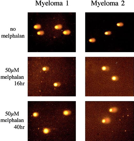Fig. 4. Analysis of melphalan-induced DNA ICL formation and repair in plasma cells using the Comet assay. / Examples of comet images obtained from a melphalan-naive (Myeloma 1) and relapsed patient following melphalan-conditioned autograft (Myeloma 2). Both patients showed similar comet tail length following 10 Gy irradiation (no melphalan). Treatment with 50 μM melphalan for 1 hour and subsequent incubation for 16 hours to allow maximum ICL formation (t = 16 hours) produced an equivalently reduced comet tail in both samples. At t = 40 hours the same level of ICLs was still present in Myeloma 1. In contrast, in Myeloma 2 the comet tail length returned to a level similar to the irradiated control, revealing extensive repair of the ICLs. All images stained with propidium iodide. Original magnification, × 20.