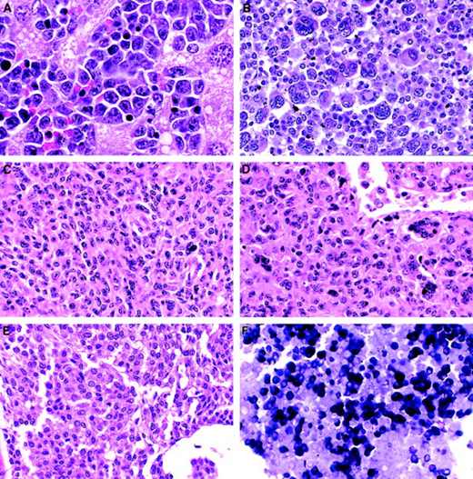 Erythroid leukemia, megakaryocytic leukemia, histiocytic sarcoma, and mast cell sarcoma in mice.