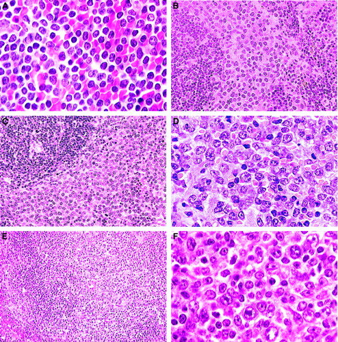 Fig. 2. B-cell lymphomas. / (A) Small B-cell lymphoma. A uniform population of small, mature, round lymphocytes within an expanded white pulp with similar cells invading the red pulp (H&E, × 750). (B) Splenic marginal zone lymphoma. Widening of the marginal zone with medium-sized B cells containing prominent eosinophilic cytoplasm with no red pulp infiltration (H&E, × 400). (C) Advanced SMZL. Evidenced by invasion of the red pulp and compression of the white pulp (H&E, × 400). (D) Advanced SMZL. Centroblastlike cells with mitotic figures obliterating normal architecture. Cytoplasm is moderately extensive (H&E, × 750). (E) Follicular B-cell lymphoma. The pale zone represents loss of small dark lymphocytes in both the periarteriolar lymphoid sheath (PALS) and follicle and replacement with mixed centrocytes and centroblasts (H&E, × 150). (F) Follicular B-cell lymphoma. Mixed population of large centroblasts, cleaved centrocytes, and small lymphocytes with few immunoblasts (H&E, × 750).
