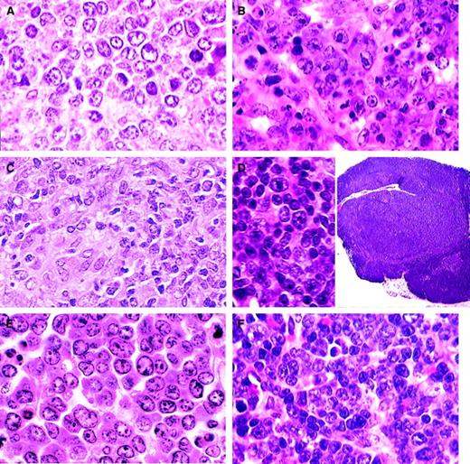Fig. 3. B-cell lymphomas. / (A) DLBCL-centroblastic. A uniform population of large centroblasts with nuclear membrane-associated nucleoli has completely replaced normal splenic structure (H&E, × 750). (B) DLBCL-immunoblastic. A pleomorphic population of immunoblasts with large nucleoli as well as some centroblasts (H&E, × 750). (C) DLBCL-histiocyte associated. A pleomorphic population of large lymphoid cells with prominent area of histiocytic cells (lower left) (H&E, × 1000). (D) DLBCL-primary mediastinal (thymic). Tumor arising in the thymus composed of a mixed population of B220+ cells (inset; H&E, × 15) including immunoblasts (H&E, × 750). (E) Classic Burkitt lymphoma. Large cells with prominent nucleoli central or in peripheral areas of the nucleus. Apoptosis is a striking feature (H&E, × 1000). (F) Burkittlike lymphoma. Medium-sized cells with central nucleoli or stipple chromatin with moderate apoptosis (H&E, × 750).