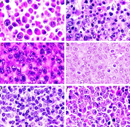 Fig. 4. Plasma cell and T-cell lymphomas. / (A) Plasmacytoma. Well-differentiated neoplasm with progression from large plasmablasts with prominent central nucleoli to mature plasma cells (H&E, × 750). (B) Plasmacytoma. Moderately differentiated with maturation of plasmablasts into plasma cells (H&E, × 750). (C) Anaplastic plasmacytoma. Large blast cells with plentiful amphophilic cytoplasm (H&E, × 750). (D) Precursor T-cell lymphoblastic lymphoma. Uniform population of medium-sized cells with central or small scattered nucleoli (H&E, × 1000). (E) T-natural killer cell leukemia. Mature small lymphocytes and some large immature lymphoblasts (H&E, × 750). (F) Large cell anaplastic T-cell lymphoma. Comprising mainly large anaplastic immunoblastlike cells with large nucleoli (H&E, × 750).