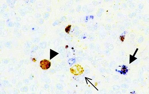 Fig. 1. Detection of active caspase 3–expressing neoplastic cells in HD in combination with CD68. / Double staining of active caspase 3 (brown) and CD68 (blue) indicates that nearly all active caspase 3–positive cytoplasmic staining is restricted to CD68-positive macrophages. (arrow) Macrophage containing active caspase 3-positive debris. (arrowhead) Active caspase 3–positive. CD68− H/RS cell with exclusive cytoplasmic staining (thin arrow). Original magnification × 630.