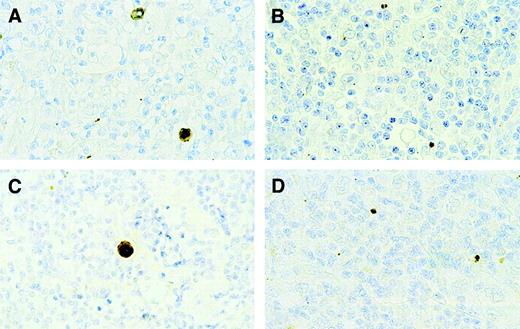 Fig. 3. Expression of active caspase 3 and PARP-1/p89 in HD. / (A) Active caspase 3 expression in a patient with HD showing 5% or more active caspase 3–positive H/RS cells. (B) Expression of active caspase 3 in a patient with HD showing less than 5% active caspase 3–positive H/RS cells. (C) PARP-1/p89 expression in the same HD patient as depicted in Figure 5A, showing comparable numbers of PARP-1/p89 and active caspase 3–positive H/RS cells. (D) Expression of PARP-1/p89. The same HD patient depicted in Figure 5B, showing expression in a few small reactive but negative H/RS cells. Original magnification × 630.