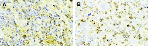 Fig. 5. Expression of procaspase 3 in HD. / (A) In this patient with HD, all H/RS cells expressed procaspase 3 at levels similar to those for the reactive infiltrating lymphocytes that served as an internal positive control. (B) Absence of procaspase 3 in the H/RS cells and strongly positive reactive lymphocytes. Expression of active caspase 3 and PARP-1/p89 in the neoplastic cells was not observed in this patient (Figure 3B,D). Original magnification × 630.