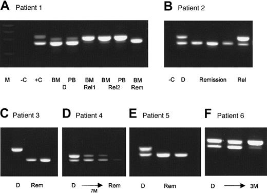 Fig. 3. Examples of 6 patients with FLT3-LM at diagnosis who were evaluated for the mutation at different follow-up time points. / M, molecular weight standard; −C, blank control; +C, positive control; BM, bone marrow; PB, peripheral blood; D, sample at diagnosis; Rel, sample at relapse; Rem, sample from remission; M, months. Patient 1 had FLT3-LM at diagnosis in the bone marrow and in the peripheral blood. At follow-up (Rel1) he had a single mutated band in complete remission 3 weeks before morphologic relapse (Rel2). He lost the wild-type allele, which was confirmed by FISH analysis (data not shown). In second remission, only the wild-type allele could be amplified. Patient 2 was studied at 3 remission time points at 3-month intervals. At all remission time points, only the normal allele was detectable. Patient 3 was hemizygous for the mutation at diagnosis and is still in remission with only the wild-type allele detectable. Patient 4 needed 7 months of conventional chemotherapy to achieve clinical remission. Patient 5 was heterozygous for the mutation at diagnosis and is in continuing clinical and molecular remission for 6 months. Patient 6 was heterozygous at diagnosis, did not achieve clinical remission, and shifted to a hemizygous state for the mutation after 3 months.