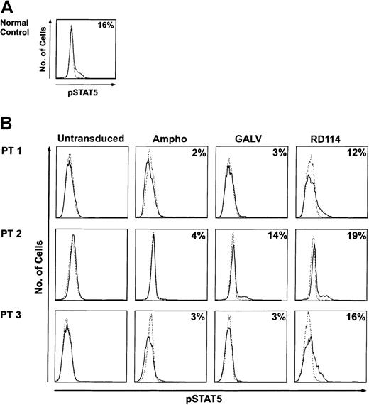 Fig. 4. Phosphorylated STAT5 (pSTAT5) as an indicator of γc signaling. / B-cell lines from a healthy control (panel A) and XSCID patients (panel B), before and after transduction. Cells were exposed (black line) or not exposed (dotted line) to IL-2, then permeabilized and stained with mouse anti-pSTAT5 and a FITC-conjugated anti–mouse secondary antibody.