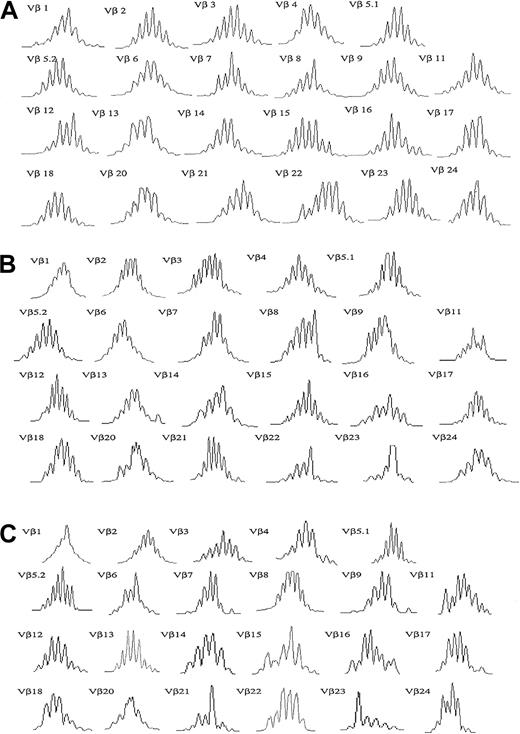 Fig. 2. T-cell repertoire diversity in healthy subjects. / Three representative example of spectratype analyses performed on 13 healthy control subjects show that most TCR-Vβ families exhibit a diverse, gaussian distribution of CDR3 lengths. However, some TCR-Vβ families do exhibit a skewed or restricted distribution of CDR3 lengths. The ages of the control subjects are (A) 31, (B) 41, and (C) 61 years.