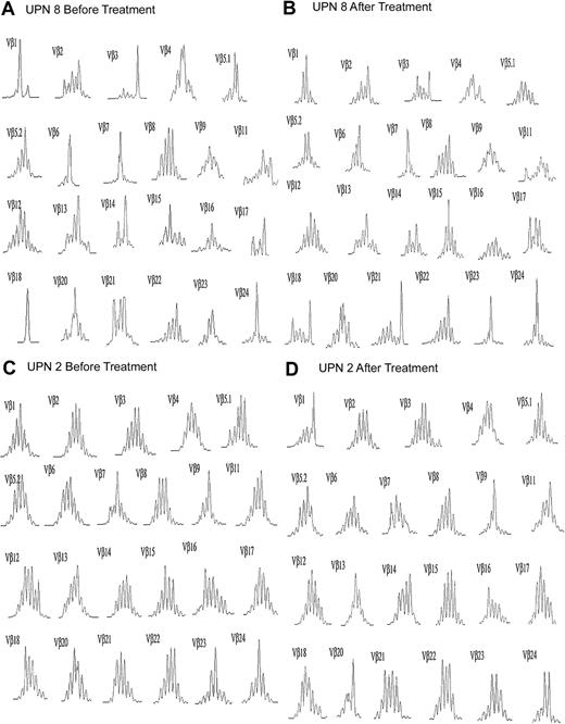 Fig. 3. Representative TCR-Vβ spectratype before and after ATG-based treatment. / Complete spectratype for (A) UPN 8, a clinical nonresponder, and (B) UPN 2, a responder.