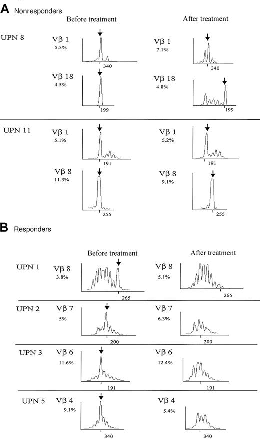 Fig. 4. Representative TCR-Vβ spectratypes from nonresponders and responders before and after ATG-based treatment. / Overrepresented CDR3 lengths on spectratype analysis persist in nonresponders to immunosuppression, but become less dominant in responders. The length in base pairs of the dominant peak is indicated on the x-axis. The y-axis represents relative fluorescence intensity. The percentages with each spectratype give the percentage of the total T-cell repertoire made up by the indicated TCR Vβ family. (A) Two representative nonresponders, and (B) the 4 responders.