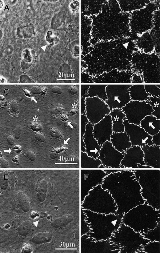 Fig. 1. VE-cadherin distribution on cultured human umbilical vein endothelial cells (HUVECs) in the presence of PMN transmigration. / (A-B) Specimens were fixed with 4% paraformaldehyde in the presence of 0.5% Triton-X 100 and subsequently immunostained with anti–VE-cadherin antibody and fluorescence-conjugated secondary antibody. (C-F) Specimens were prelabeled with the primary antibody against VE-cadherin, fixed, and finally labeled with the secondary antibody. Confocal fluorescence micrographs B, D, and F were taken from the same specimens from which phase-contrast micrographs A, C, and E were taken. Triangle symbols indicate the locations of transmigrating PMNs. PMNs on top of the endothelial cells are marked by arrows, and PMNs already transmigrated are marked by asterisks.