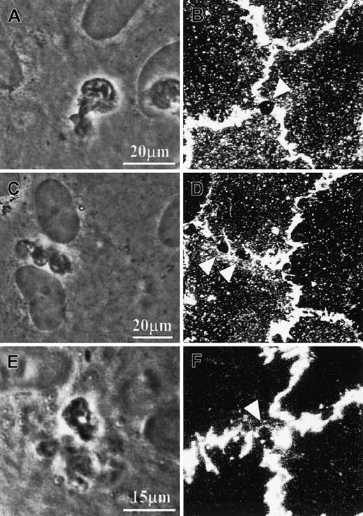 Fig. 2. PECAM-1 distribution on cultured HUVECs during PMN transmigration. / (A-D) Specimens were fixed with 4% paraformaldehyde in the presence of 0.5% Triton-X 100 and subsequently immunostained with anti–PECAM-1 antibody and fluorescence-conjugated secondary antibody. (E,F) Specimens were prelabeled with the primary antibody against PECAM-1, fixed, and finally labeled with secondary antibody. Confocal fluorescence micrographs B, D, and F were taken from the same specimens from which phase-contrast micrographs A, C, and E, respectively, were taken. Triangle symbols point at the stain-free areas, which correspond to the PMNs' pseudopodia that were penetrating the endothelial monolayer. Note: 2 pseudopodia from the same PMN might simultaneously penetrate the endothelial monolayer (C-D).