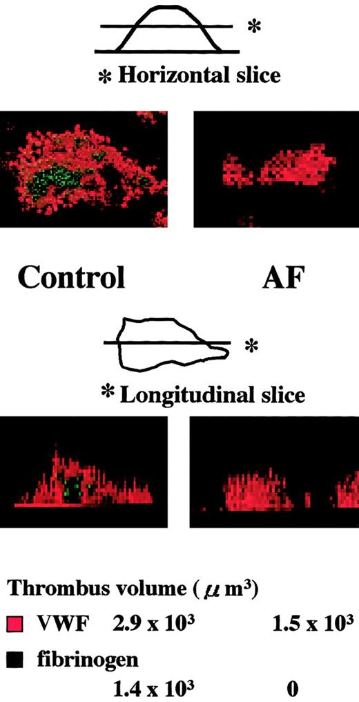 Fig. 5. Analysis of thrombi generated during perfusion of blood from normal controls or an AF patient under high shear rate conditions. / Experimental conditions were as described in the Figure 4 legend, except that AF blood was also perfused. Top images (original magnifications, × 400) are horizontal views, obtained at a height of 15 μm from the collagen surface, of thrombi generated after 7-minute perfusion of blood from a healthy control or from a patient with AF under a high shear rate (1500 s−1); bottom images are the corresponding longitudinal views, synthesized using imaging analysis software of the CLSM system based on overall horizontal slices at the identical positions with 1-μm intervals. The VWF- or fibrinogen-associated volume within each normal or AF thrombus displayed in the upper panels was also indicated. In the healthy control, fibrinogen is distributed at the inner or core areas of thrombi, whereas VWF is distributed predominantly in the outer areas. In contrast, only VWF appears in the AF thrombi, which appear flatter than control thrombi.