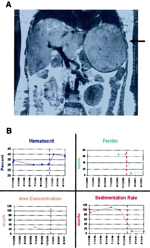 Fig. 1. Laboratory findings in patient A before and after adenoma resection. / (A) An MRI scan performed prior to resection (August 30, 2000) shows a 13 × 14 cm adenoma in the left lobe of A's liver (arrow). (B) Individual panels illustrate changes in hematocrit, serum ferritin concentration, serum iron concentration, and erythrocyte sedimentation rate for approximately 1 year before and 6 months after resection (performed December 15, 2000). The serum ferritin was initially above the normal range but fell to subnormal levels after the tumor was resected, and erythroid iron utilization returned to normal.