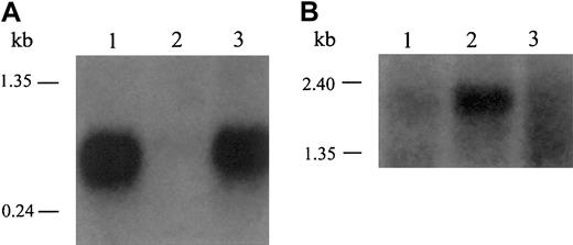 Fig. 3. Inappropriate expression of hepcidin in adenoma tissue from GSD patients. / (A) Hepcidin is abundantly expressed in liver tissue from a healthy adult male (lane 1) but significantly decreased in the unaffected liver tissue from patient A (lane 2). In contrast, hepcidin mRNA expression in the adenoma tissue from patient A (lane 3) was considerably greater than the adjacent liver and similar to that of control liver. (B) We reprobed the same Northern blot for β-actin to control for RNA loading. These results are representative of 3 experiments without significant variation between experiments.