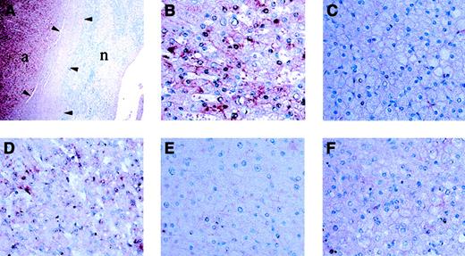 Fig. 4. In situ hybridization analysis of hepcidin mRNA expression. / Hepcidin mRNA expression is low in unaffected liver tissue when compared with the adenoma tissue of patients A (A-C,F) and B (D,E). Adjacent adenoma tissue and unaffected liver tissue visualized at a magnification of × 10. (A) shows hepcidin mRNA expression is significantly greater in the adenoma. Adenoma tissue is indicated by “a,” and unaffected liver tissue is indicated by “n.” Arrowheads indicate the region occupied by the capsule at the interface between the liver and adenoma. Higher power (original magnification, × 100) confirmed that hepcidin mRNA expression is lower in hepatocytes of normal tissue (C,E) as compared with adjacent adenoma tissue (B,D) from the same tissue section. Hybridization with a hepcidin probe from the sense strand acts as a control for nonspecific staining (F). These results are representative of 2 experiments without significant variation between experiments.