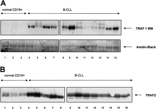 Fig. 3. TRAF 1 and TRAF2 protein expression in normal and neoplastic B cells. / (A) TRAF1 protein was analyzed in normal CD19+ B cells (lanes 1-3) and B-CLL samples (lanes 4-15). A quantity of 20 μg total protein was used per lane. Amido-black staining indicated similar amounts of protein being loaded per lane. (B) TRAF2 protein was analyzed in normal CD19+ B cells (lanes 1-3) and B-CLL samples (lanes 4-16). A quantity of 20 μg total protein was used per lane.