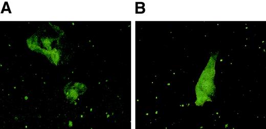 Fig. 1. EBV protein expression in cells from an ulcerative lesion from patient no. 5. / Epithelial cells obtained from a genital lesion from patient no. 5 were dried onto poly-L-lysine–coated slides and fixed in a chilled 1:1 mixture of methanol and acetone, blocked with 20% normal goat serum, stained with primary antibody for BZLF1 (Argene) or LMP-1 (mouse monoclonal OT22C), then stained with fluorescein isothiocyanate (FITC)–conjugated goat anti–mouse IgG. Slides were mounted with coverslips using Vectashield (Vector Laboratories) and then subjected to confocal microscopy. Panel A shows staining with BZLF1 and panel B shows staining with LMP-1.