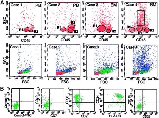 Fig. 3. Representative examples of gating of blasts by 3-color FCM. / (A) Data are shown for 4 cases for which the BR interface contained various percentages of blasts. The percentages of blasts determined in cytospin preparations were 96%, 17%, 66%, and 22% for cases 1 through 4, respectively. The samples subjected to BR density centrifugation were PB for cases 1 and 2 and BM cells for cases 3 and 4. The upper panels are CD45 versus SSC displays in which R1, R2, R3, and R4 are gates for blasts, lymphocytes, monocytes, and erythroid cells, respectively. The rectangle in case 4 shows the gate for myeloid cells other than myeloblasts. The gated cells in R1 through R4 are shown as green, red, black, and yellow dots, respectively, in the lower panels, which show the FSC versus SSC displays for each case. (B) Examples of antigen expression analysis of blasts (cells in R1) by FCM for case 4.