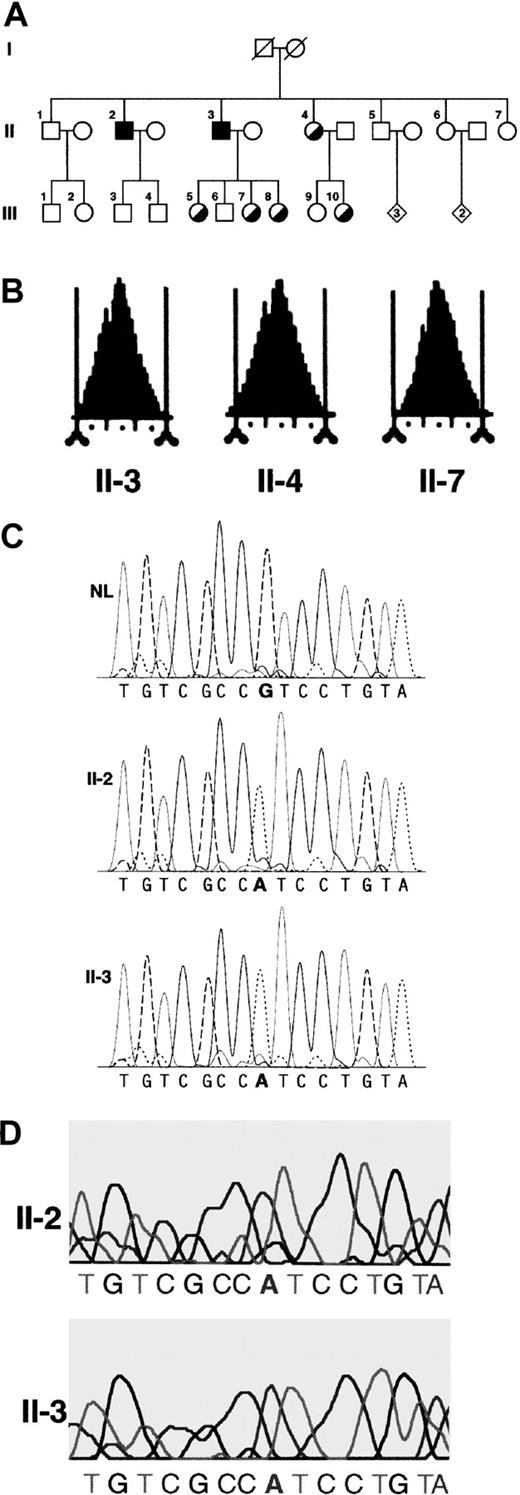 Fig. 1. Most relevant clinical and molecular findings in the family studied. / (A) Pedigree of the family studied. Circles denote female family members; squares, male family members; and diamonds, additional members of either sex (the number of additional members is shown in the diamonds). Symbols with diagonal lines indicate deceased members. Filled squares indicate hemizygous males; half-filled circles indicate heterozygous women. (B) Red cell volume histograms obtained with a Bayer Technicon H3 in 3 family members. The vertical tick marks correspond to 10 fL increments. Subject II-7 shows a typical normal picture. Subject II-4 is a typical heterozygous woman with a small proportion of microcytic red cells (tail on the left side of the histogram). The nonanemic hemizygous brother (subject II-3) shows a red cell volume histogram that is almost normal. (C) Dideoxy dye terminator sequence analysis of polymerase chain reaction–amplified, exon 11 genomic DNA from a healthy individual (NL), the proband (II-2), and his brother (II-3). (D) Sequence analysis of reverse transcribedALAS2 mRNA expressed in reticulocytes from the anemic (II-2) and nonanemic (II-3) hemizygous brothers.