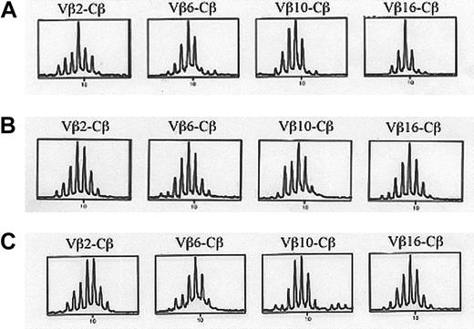 Fig. 4. TCR Vβ repertoire analysis. / Eleven months after gene transfer, 24 Vβ-specific amplifications were performed to test Vβ diversity and analyzed following the immunoscope technique. Two mice were tested. Representative Vβ2, Vβ6, Vβ10, and Vβ16-Cβ amplifications from a RAG-2–transduced mouse (A), a mock-transduced mouse (B), and a C57BL/6 wild-type mouse (C) are represented.