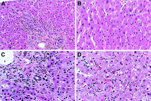 Fig. 1. Histologic changes of liver GVHD. / Characteristic histology of classical liver GVHD with bile duct lymphocytic infiltrates and injury. (A) Portal lymphocytic inflammation is also present. (B) Lobules show mild hemosiderin accumulation with no significant inflammation. (C) Hepatitic-variant liver GVHD demonstrates only mild chronic inflammation of the portal tracts, with minimal bile duct changes. (D) In contrast, the lobules show definite hepatitis. Original magnification × 25; hemotoxylene-eosine staining.