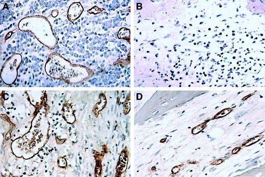 Fig. 5. Microvessels in sections of decalcified human bones of thalidomide-responsive myelomatous SCID-hu B+L hosts. / (A-B) Patient 9; (C-D) patient 10. Microvessels in sections from CMC-treated (A,C) and thalidomide-treated (B,D) SCID-hu hosts were visualized using immunohistochemical staining for human CD34 expression.