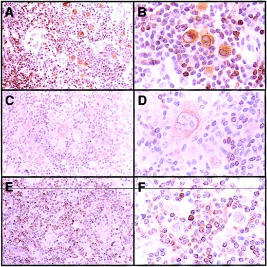 Fig. 1. BCL-2 expression in HRS cells of cHD. / (A-B) Nodular sclerosis with strong expression of BCL-2 in HRS cells. (C-D) Mixed cellularity with weak BCL-2 expression in HRS cells. (E-F) Nodular sclerosis with BCL-2− HRS cells. The small reactive lymphocytes stained positively for BCL-2 and served as internal positive controls in all panels. Original magnifications A, C, E, × 100; B, D, F, × 400.