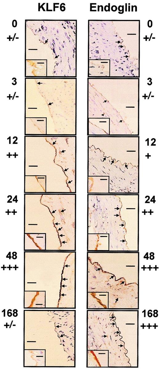 Fig. 1. Colocalization of KLF6 and endoglin in arterial endothelial cells after carotid balloon injury in rats. / The distal half-carotid artery of rats was injured with a balloon catheter. At 0, 3, 12, 24, 48, and 168 hours after injury (as indicated beside each photo), the carotid was perfusion fixed with 3% paraformaldehyde, excised, and paraffin embedded. Sections were stained with antiendoglin (right panels) or anti-KLF6 (left panels), as described in “Materials and methods.” Panels show the staining pattern of the adjacent proximal half of the carotid artery. Arrows indicate staining of the endothelial layer and some scattered cells present in the tunica media. An inset in each panel represents the immunostaining at higher original magnification (× 1000), whereas the main figures are shown at × 200 original magnification. Bars represent 50 μm (main figures) or 1 μm (insets). Estimations of relative levels of KLF6 and endoglin at different time points are indicated below time markers.