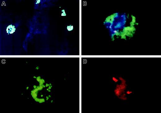Fig. 2. Example of a blood smear of a patient with trisomy 8 stained for activated caspase-3. / Freshly obtained blood smear was stained for activated caspase as described in “Patients, materials, and methods” and then subjected to FISH. A low-power view of cells staining for activated caspase is seen in panel A. A close-up view of a trisomy 8 cell, also positive for caspase-3, is seen in panel B. The same cell visualized with either a green or red bandpass filter showing caspase staining (C) and trisomy 8 probe (D). Original magnification × 100.