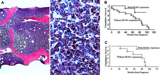 Fig. 1. Morphologic evaluation and survival analysis. / (A) Example of marrow biopsy sample with diffuse involvement pattern (left) and absence of MUM1/IRF4 expression (right), defined as less than 20% of CD20+ B cells stained positively for MUM1/IRF4. Double staining for MUM1/IRF4 (brown; nuclear staining) and CD20 (red; membrane staining) shows that most CD20+ B cells do not express MUM1/IRF4. Cells that are positive for MUM1/IRF4 but negative for CD20 represent activated T cells or plasma cells (arrows). Double staining was performed, after heat retrieval, by incubating the marrow biopsy sections with monoclonal antibody against MUM1/IRF4 (1:200 dilution) for 30 minutes, detected by DAB chromogen (DAKO), followed by the second incubation with monoclonal antibody against CD20 (1:800 dilution) for 30 minutes, detected by Vector-Nova Red (Vector, Burlingame, CA). All slides were stained using the DAKO automated immunostainer. In some patients, the monoclonal antibody (MUM1p, a kind gift from Dr B. Falini, University of Perugia, Italy) was used for double staining. Results were comparable between the 2 antibodies. (B) Patients without MUM1/IRF4 expression had significantly worse OS than those with MUM1/IRF4 expression (Kaplan-Meier survival analysis;P < .03, log-rank test). (C) Among patients with interstitial/nodular marrow involvement, patients with MUM1/IRF4 expression had significantly better OS than those without (Kaplan-Meier survival analysis; P < .02, log-rank test).