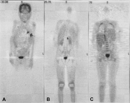 Fig. 1. Use of coronal emission fluorodeoxyglucose–positron emission tomography (FDG-PET) in patient 6 with multifocal aspergillosis. / Coronal emission FDG-PET before (panels A and B) and 3 months after (panel C) HSCT in patient 6 with multifocal aspergillosis. PET shows multiple lesions in the lungs and a focus in the upper-left psoas with intense FDG uptake before HSCT; these have disappeared at 3 months after HSCT. Physiologic high-FDG uptake is seen in the brain and bladder.