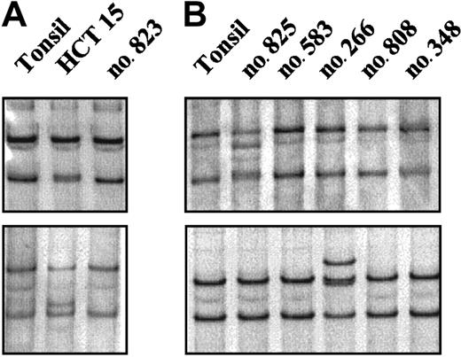 Fig. 1. RT-PCR–SSCP analysis of the. / CHK2 gene. (A) The abnormal mobilities observed in the HCT15 cell line corresponded to the previously described missense mutations Ala247Asp (top) and Arg145Trp (bottom). (B) Case no. 825 (top) showed a distinct mobility shift that corresponded to an aminoacid substitution at codon 157 (ATT>ACT) leading to an Ile→Thr change. Case no. 266 (bottom) showed an altered mobility that was also found in 2 more lymphomas corresponding to a silent polymorphism at codon 84 (GAA>GAG).