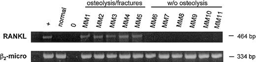 Fig. 6. RANKL mRNA expression by BM T lymphocytes from MM patients. / Analysis of IL-7 and β2-microglobulin mRNA by RT-PCR in purified bone marrow CD3+ T cells obtained from MM patients either with extensive osteolysis or without bone lesions. The osteosarcoma cell line Saos-2 was used as positive control.