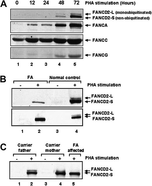 Fig. 2. Primary lymphocytes from patients with Fanconi anemia fail to monoubiquitinate FANCD2. / (A) Lymphocytes isolated from healthy control volunteers were stimulated with PHA for up to 72 hours prior to immunoblotting with antibodies against the indicated FANC proteins. Expression levels of all 4 Fanconi proteins rose following 72 hours of PHA stimulation. (B) Protein extracts of lymphocytes isolated from healthy control volunteers or from patients with Fanconi anemia were immunoblotted for FANCD2 following PHA stimulation. Although the lymphocytes from healthy control volunteers showed both the unmodified (FANCD2-S) and the monoubiquitinated (FANCD2-L) FANCD2 forms, the lymphocytes from the patients with Fanconi anemia showed only the lower unmodified FANCD2-S form. (C) Protein extracts from lymphocytes from obligate FA heterozygous carriers were immunoblotted for FANCD2 following PHA stimulation.