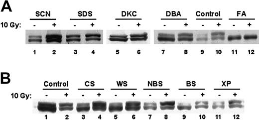 Fig. 3. FANCD2 monoubiquitination is normal in other inherited bone marrow failure and chromosomal instability syndromes. / (A) EBV-immortalized lymphocytes from patients with the indicated bone marrow failure syndromes were harvested before or 6 hours after treatment with 10 Gy radiation. Cell lysates were analyzed by immunoblotting with an anti-FANCD2 FI17 monoclonal antibody. FA indicates Fanconi anemia; SCN, severe congenital neutropenia; SDS, Shwachman-Diamond syndrome; DKC, dyskeratosis congenita; and DBA, Diamond-Blackfan anemia. (B) EBV-immortalized lymphocytes from patients with the indicated chromosomal breakage syndromes were harvested before or 6 hours after treatment with 10 Gy radiation. Cell lysates were analyzed by immunoblotting with an anti-FANCD2 FI17 monoclonal antibody. CS indicates Cockayne syndrome; WS, Werner syndrome; NBS, Nijmegen breakage syndrome; BS, Bloom syndrome; and XP, xeroderma pigmentosa.