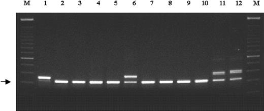 Fig. 1. Detection of FLT3 ITD in younger adults with AML. / Exons 14 and 15 of the FLT3 gene were PCR amplified from genomic DNA, and PCR products were resolved on a 2% agarose gel stained with ethidium bromide. Arrow indicates the normalFLT3 gene product (328 bp). High-molecular–weight bands represent FLT3 ITDs. Sample 1 shows a strong mutant band and loss of the wild-type allele. M indicates 100-base pair DNA ladder (Gibco BRL); 1-12, samples from 12 different AML patients.